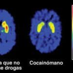 Cocaína: Tipos Y Efectos De Esta Droga Y Cómo Afecta Tu Salud Mental