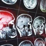 Amnesia Anterógrada: Cuando Nuestro Cerebro Se Niega A Aprender