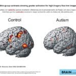 El Cerebro De Los Niños Con Trastorno Del Espectro Autista (TEA)